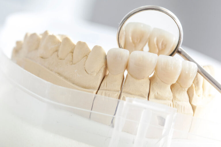 Closeup Modell eine Unterkiefers mit Keramikbrücke und Mundspiegel