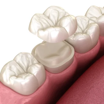 3D- Rendering einer Zahnreihe mit Zahnkrone