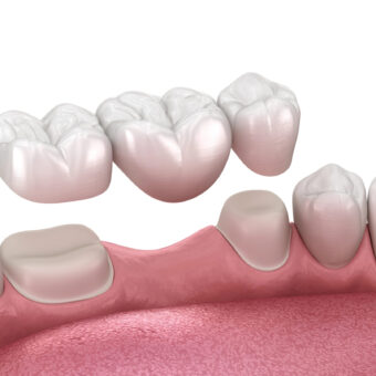 Brücke, Zähne auf weißem Hintergrund