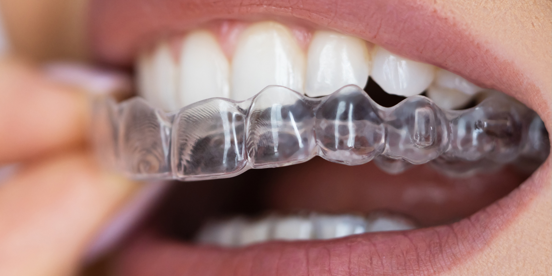 Schienentherapie bei CMD: Knirscherschiene