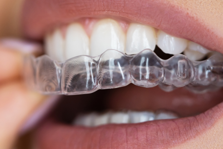 Schienentherapie bei CMD: Knirscherschiene